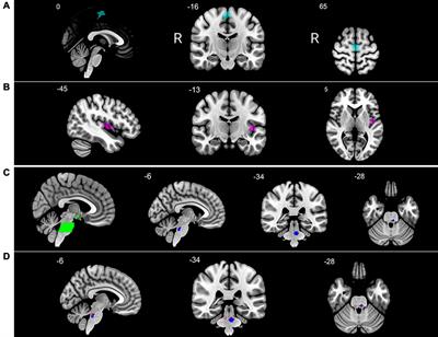 Regular Practice of Autogenic Training Reduces Migraine Frequency and Is Associated With Brain Activity Changes in Response to Fearful Visual Stimuli